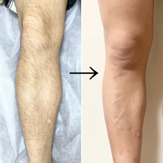 脚脱毛